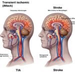 TIA vs stroke